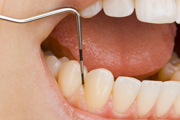 成人の80%が歯周病、またはその予備軍と言われています