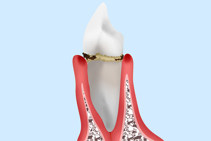 歯周病の原因と症状